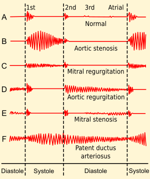 heart sounds